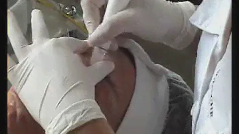 Bentlon Micrabrader treatment